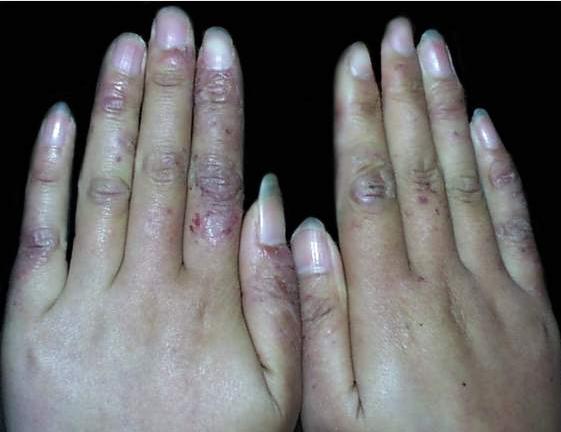 冻疮会一下子肿起来吗,冻疮会使手变粗