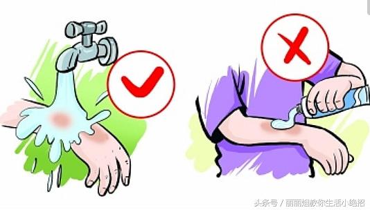 不谨慎烫伤了要涂什么药,不谨慎烫伤要怎么样才可以不烫