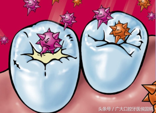 第一上磨牙是龋齿怎么办,乳磨牙出现龋齿大洞怎么办