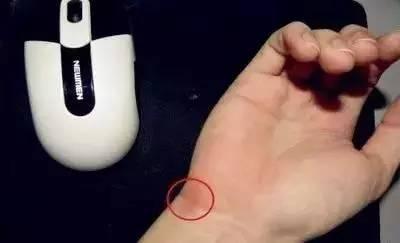 经常用鼠标手腕磨得发红怎么办,用鼠标手腕长茧