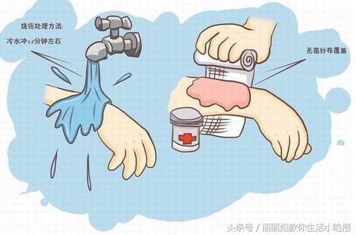 不谨慎烫伤了要涂什么药,不谨慎烫伤要怎么样才可以不烫