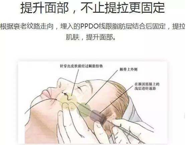 经常做线雕对面部抗衰有哪些帮助,线雕抗衰