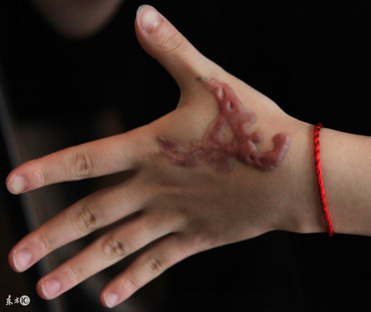 水火烫伤中草药治疗,水火烫伤急救法