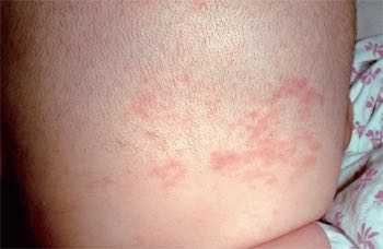 小孩生下来脸上有红胎记能治吗,剖腹产出来宝宝脸上有红胎记