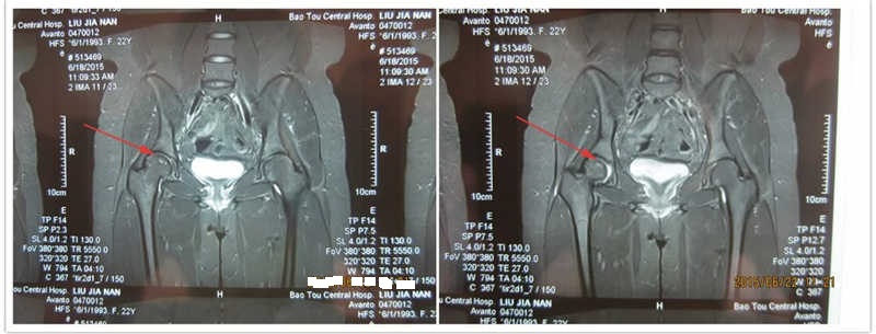 髋关节股骨头坏死四个严重误区,股骨头坏死恐慌怎么办