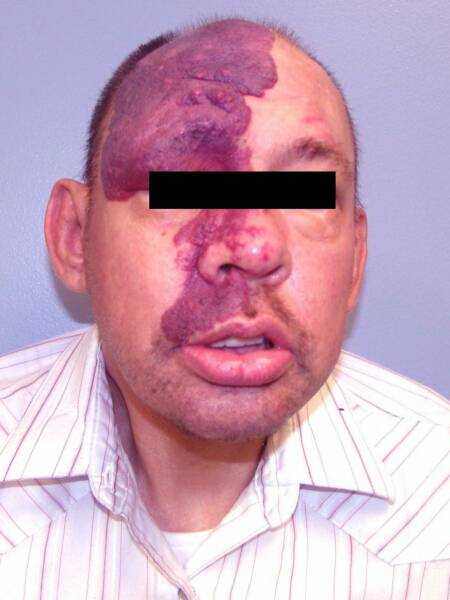 小孩生下来脸上有红胎记能治吗,剖腹产出来宝宝脸上有红胎记