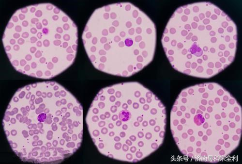 鼻息肉术后为什么会复发,鼻息肉手术后又复发了怎么处理