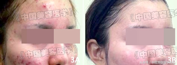 脉冲染料激光和强脉冲光,光电治疗痤疮多少钱