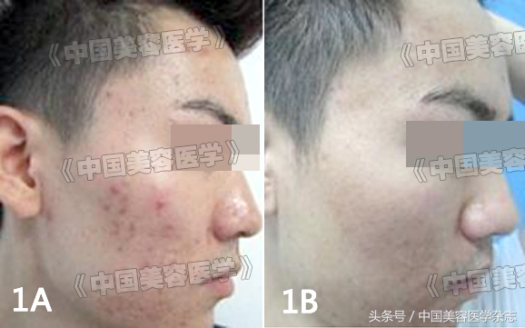 脉冲染料激光和强脉冲光,光电治疗痤疮多少钱