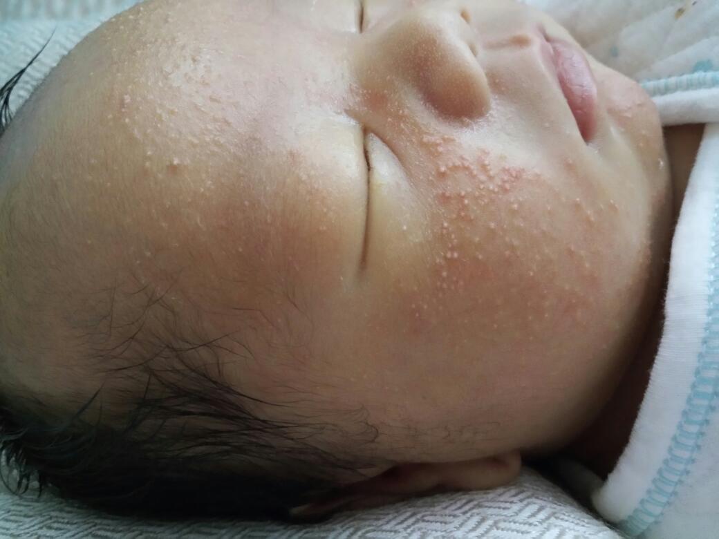 孩子刚出生需要吃什么预防长疮,九个月的宝宝长疮怎么治