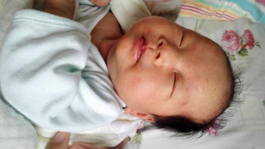 新生儿寒冷损伤症的护理措施,发生新生儿寒冷损伤综合征的原因