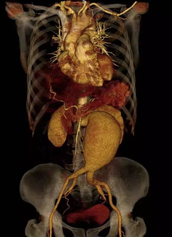 腹主动脉瘤腔内修复术多少钱,腹主动脉瘤怎么自测