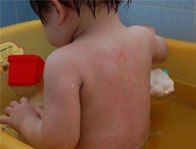宝宝是长痱子还是湿疹该如何护理,小婴儿脸上脂溢性湿疹怎么护理