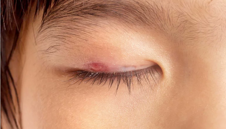 眼睛变红快速治疗方法,眼睛变红的小技巧