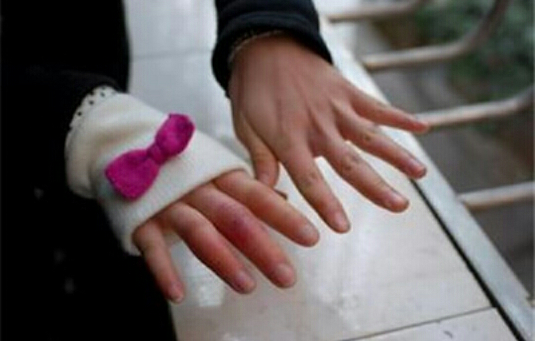 冻伤疮什么意思,冻疮的治疗方法