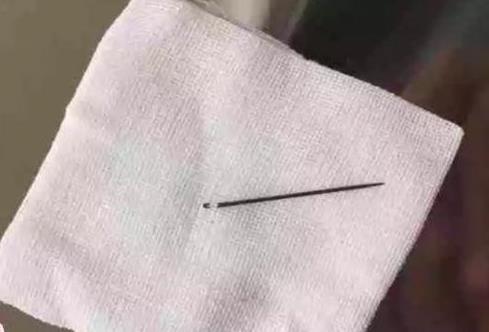插入男童腹部的三根绣花针,男孩把绣花针塞进医院