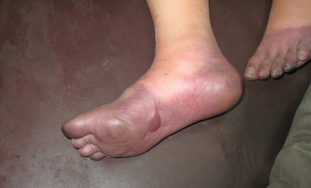 冻伤疮什么意思,冻疮的治疗方法