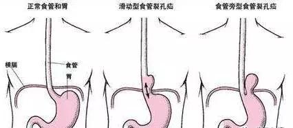 天气再冷，过烫的食物也别急着吃，一不谨慎就……