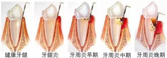 采访牙齿松动,牙齿牙龈出血红肿松动是怎么回事