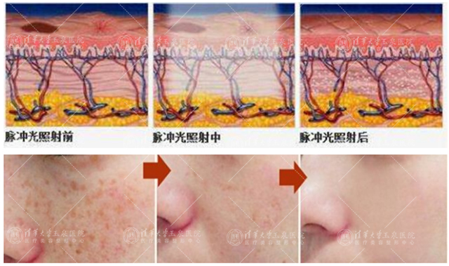 光子嫩肤祛斑后怎么看效果,光子嫩肤去黑点