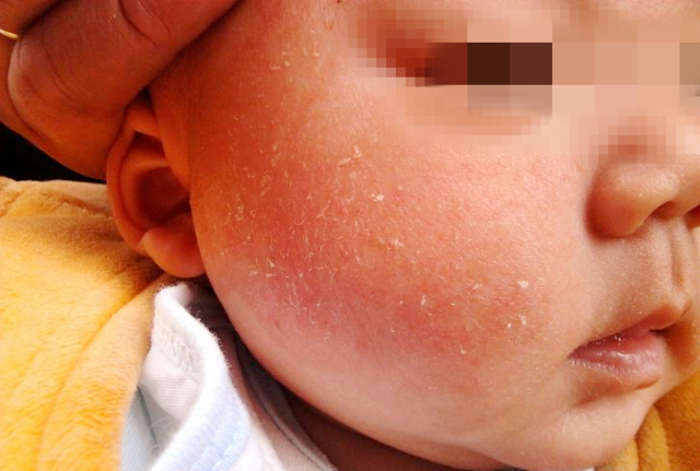 宝宝手起倒刺只需2步快速解决,6个月宝宝手长倒刺怎么办