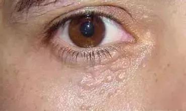 脸上有小疙瘩小颗粒解决办法,脸上小疙瘩怎么处理