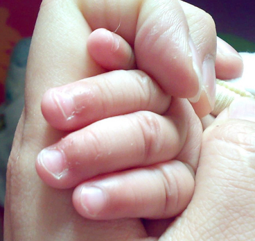 宝宝手起倒刺只需2步快速解决,6个月宝宝手长倒刺怎么办