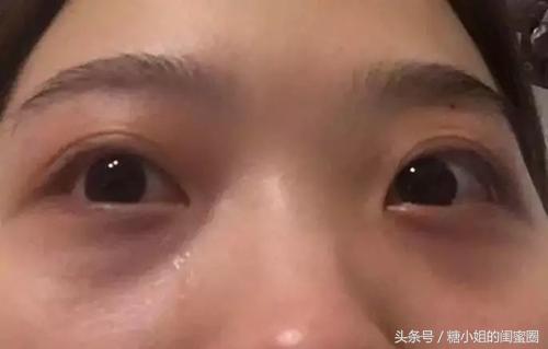 怎么拯救眼袋和泪沟,如何才能拯救我的黑眼圈大眼袋