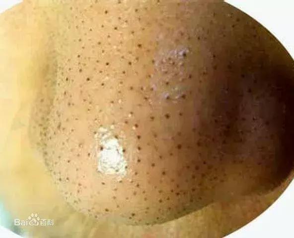 脸上有小疙瘩小颗粒解决办法,脸上小疙瘩怎么处理