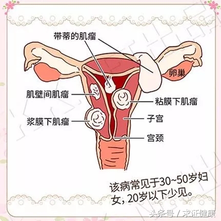 怀孕为啥长子宫肌瘤,年纪轻轻为什么有子宫肌瘤