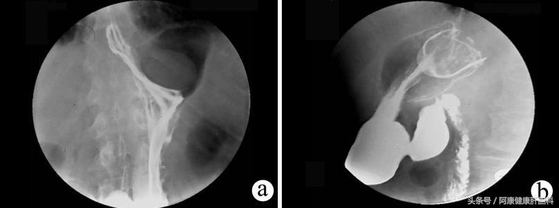 间质瘤是恶性肝癌吗,间质瘤会遗传给下一代吗