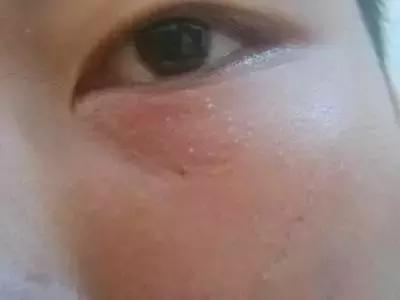 脸上有小疙瘩小颗粒解决办法,脸上小疙瘩怎么处理