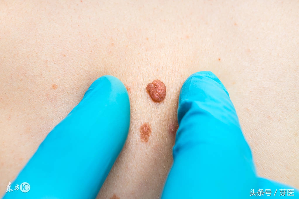 人体为什么会出现黑痣和红痣,从小就有凸起的痣是黑色素瘤吗