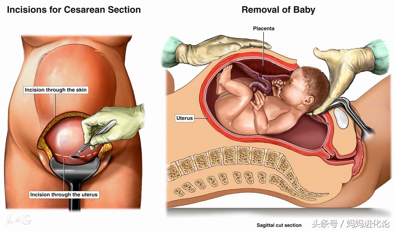 剖腹产第一天如何护理,剖腹产后第一天怎么护理