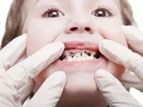 儿童牙齿黑乎乎的,孩子牙齿里面黑黑的怎么回事