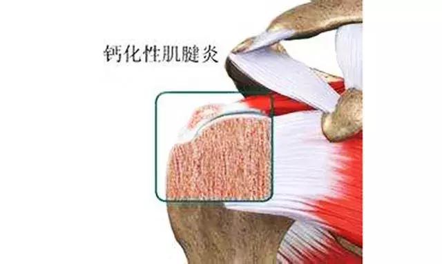 手脚冰凉后背肩疼是什么病,肩疼怕风怕冷是什么病