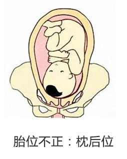 产妇胎位不正医生纠正难产完整版,孕妇胎位不正什么原因导致的