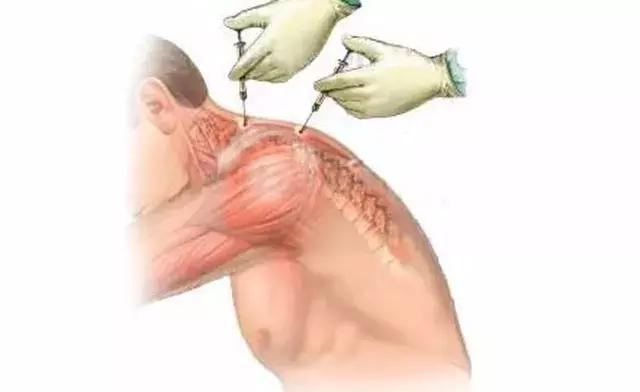 手脚冰凉后背肩疼是什么病,肩疼怕风怕冷是什么病