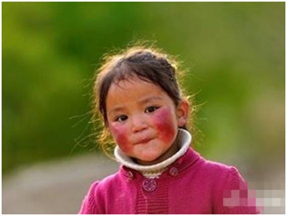 高原红应该怎么治疗,高原红如何处理