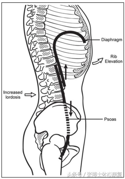 吹气球改善腹内压,吹气球治疗腰痛