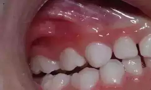儿童牙齿黑乎乎的,孩子牙齿里面黑黑的怎么回事