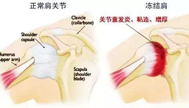 手脚冰凉后背肩疼是什么病,肩疼怕风怕冷是什么病
