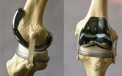 膝盖有问题应该如何保养和锻炼,3个动作自测关节