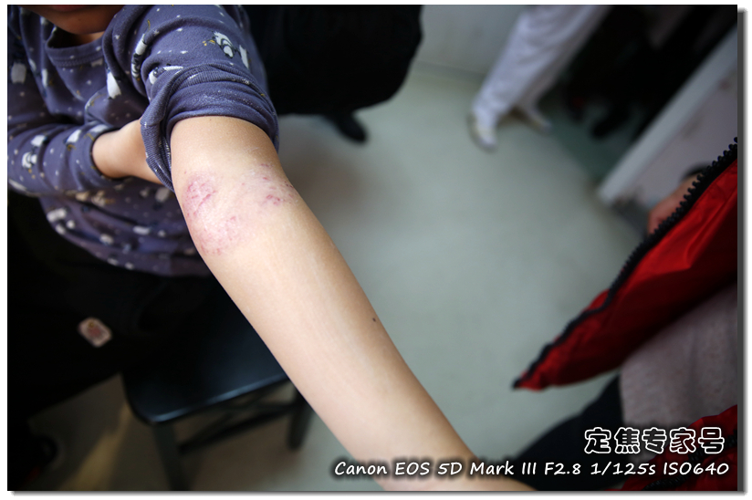 头皮癣治疗要多少钱,治疗头皮型银屑病需要多少钱