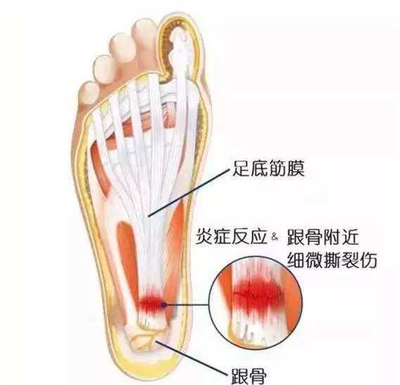 骑车感觉脚疼怎么回事,骑车脚内侧疼是怎么回事