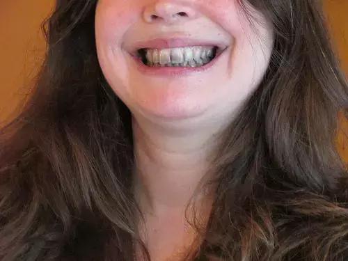 喝完酒牙齿发涩,喝酒后嘴唇紫是什么原因