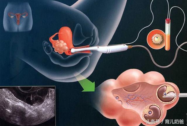 试管婴儿怎么回事,试管婴儿到底怎么回事