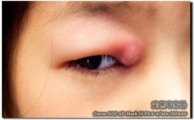 「热点」眼科专家门诊淘干货之二：眼睛总有分泌物是不是遗传，需要手术吗？