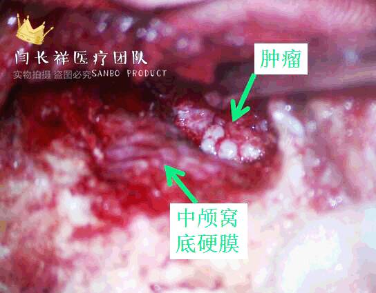 烦人的耳鸣,烦人耳鸣