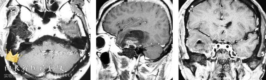 烦人的耳鸣,烦人耳鸣